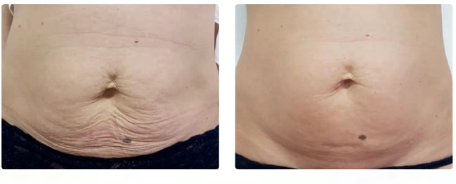 resultat traitement cellulite tunisie