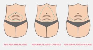 abdominoplastie type post opératoire