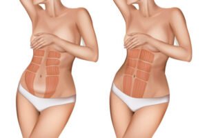 diastasis muscles grands droits