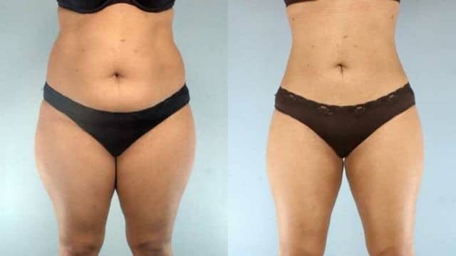 Liposuccion ventre et hanches en Tunisie